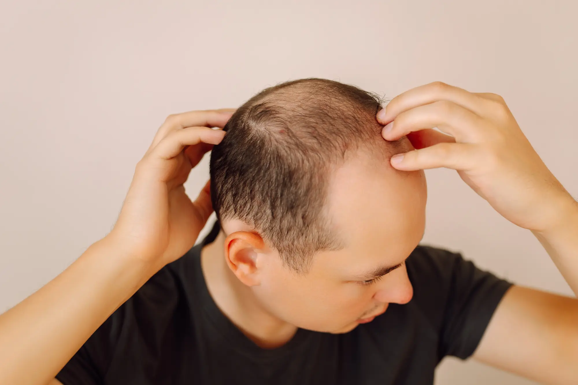 An example of Androgenic Alopecia